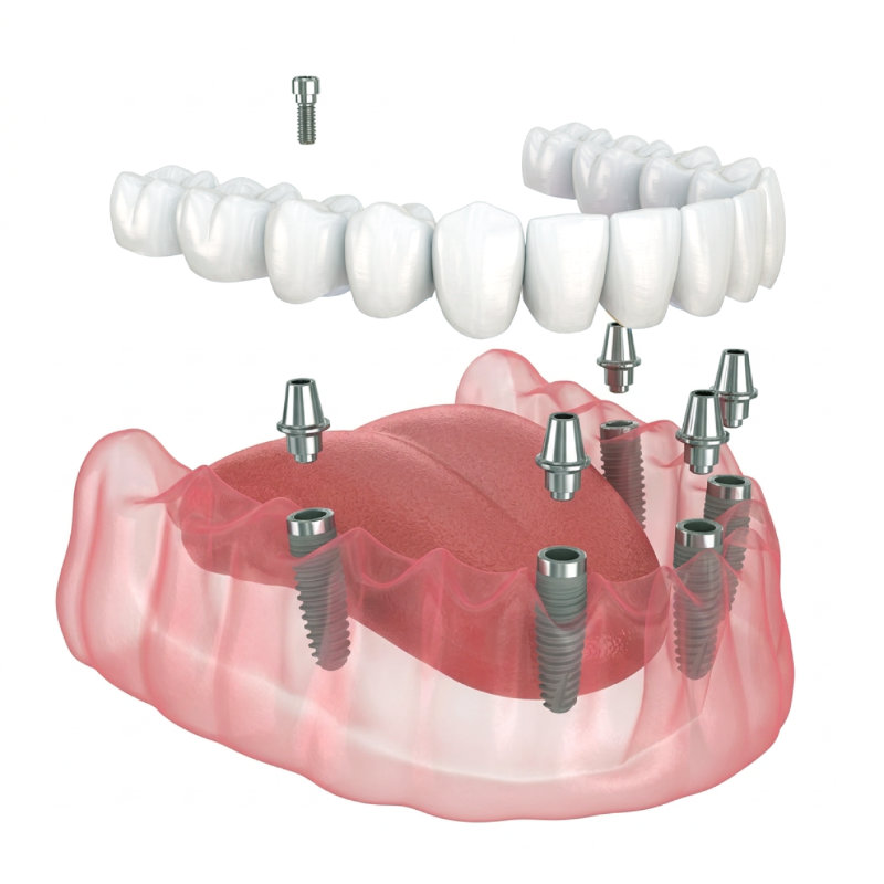 Illustration showing All-on-X dental implants placed in the jawbone to support a full arch